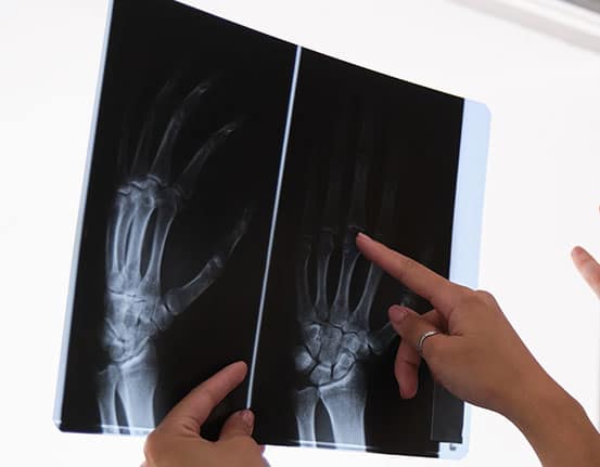 STARS-R_Tile A rheumatologist examines hand joints on an x-ray